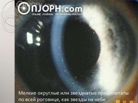 преципитаты на роговице